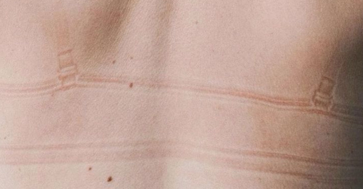 Why Your Bra Leaves Marks on Your Skin (Normal or Not?)
